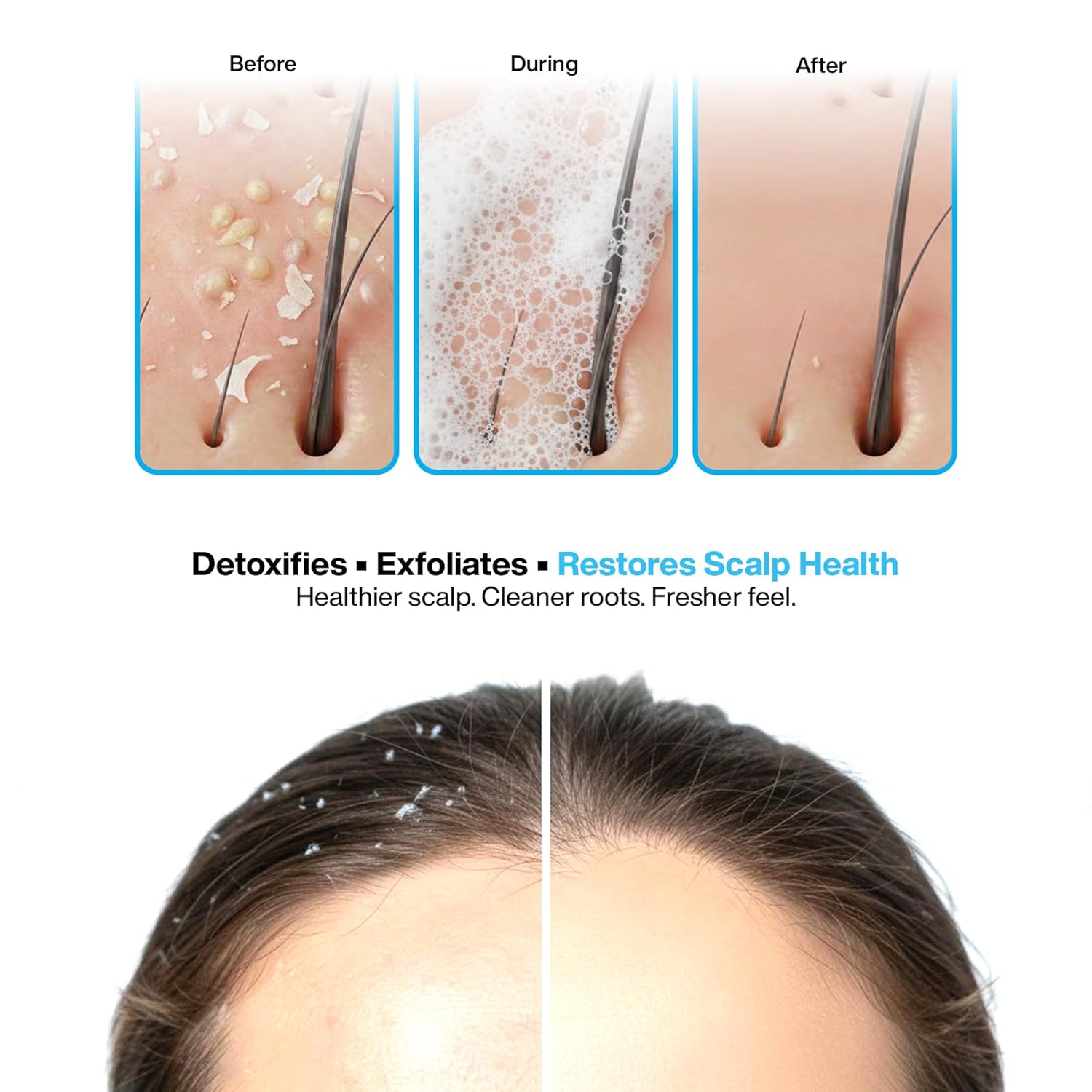 Yumedics Scalp Dose Sebo Anti Dandruff Shampoo | 150ml Liquid Anti Dandruff Shampoo for Women & Men | For Scalp Care, Sebum Control and Scalp Soothing