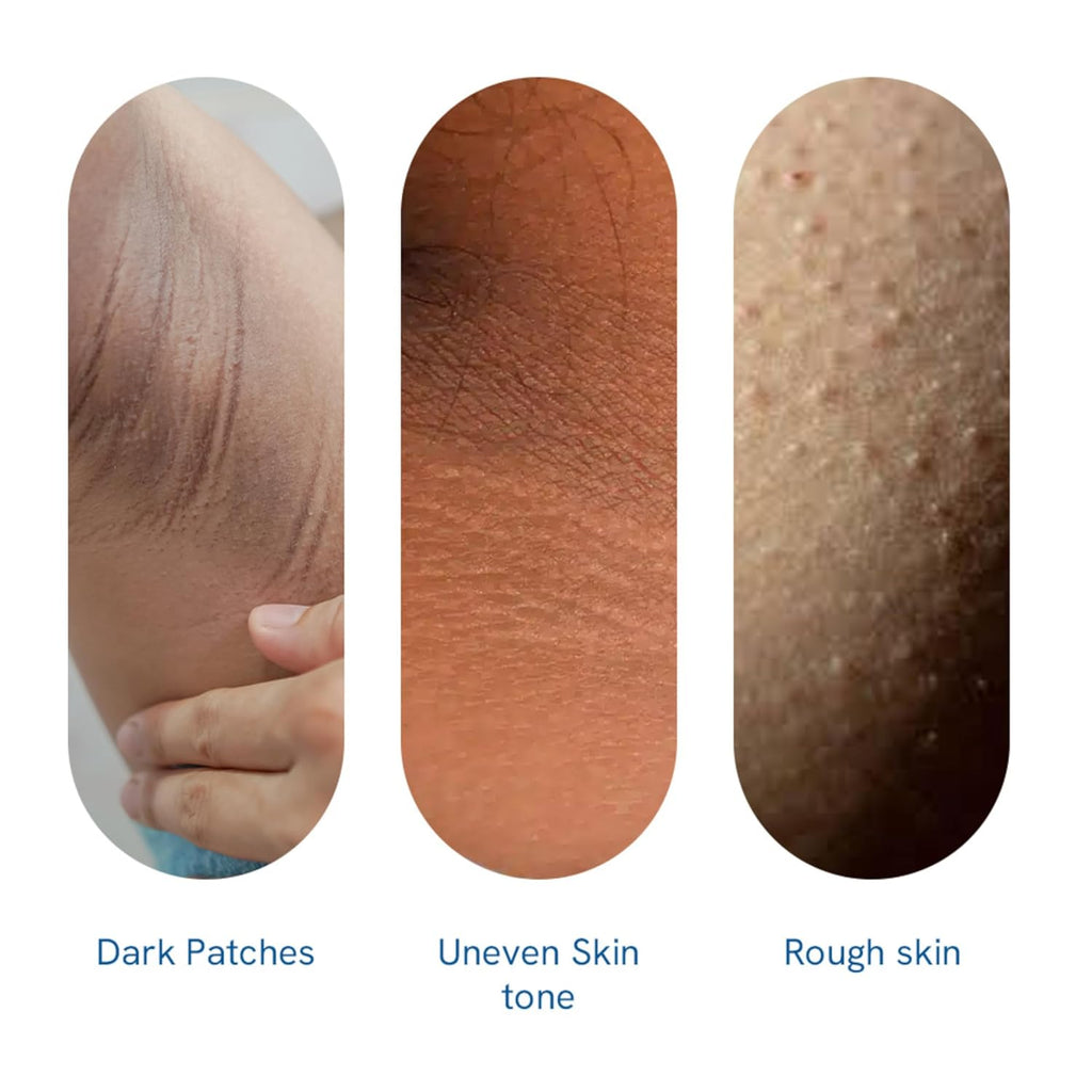 Be Bodywise Pigmentation Cream 100gm | 2.5% Lactic Acid, 2% Urea, Retinol & Kojic Acid | Reduces Tan, Pigmentation & Evens Skin Tone | Treats Dark Patches & Rough Skin on Elbows, Knees, Back of Neck & Thighs | For Daily Use