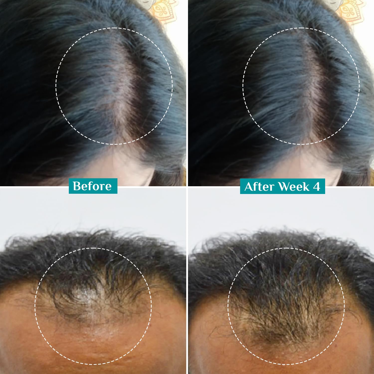 PILGRIM Redensyl 3%+Anagain 4% Advanced Hair Growth Serum For Scalp(50Ml) With Natural Ingredients Korean Black Rice,Controls Hair Fall,Stimulates,Increases Hair Density|Hairgrowth Serum For Unisex
