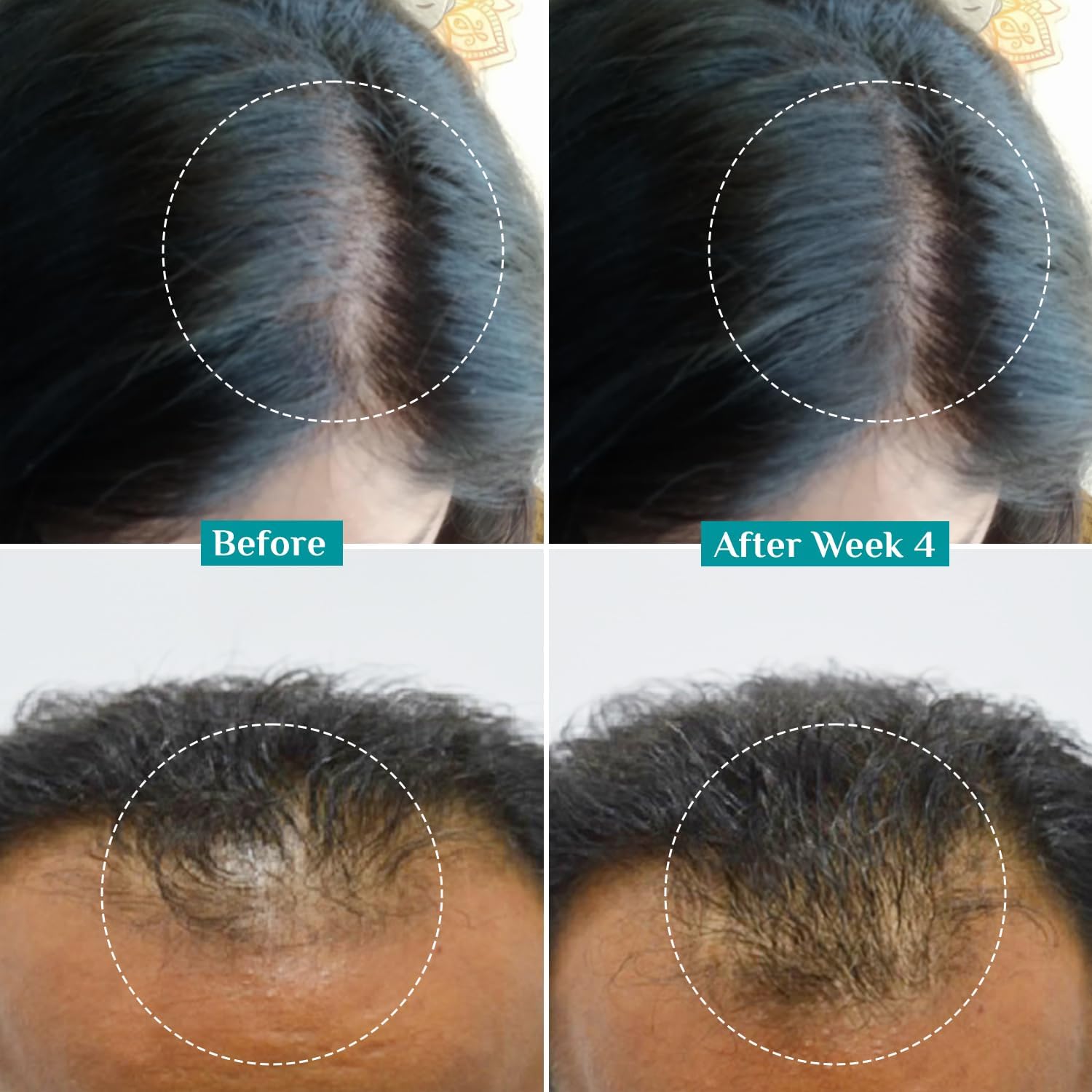 Pilgrim Redensyl 3% + Anagain 4% + 5% Capilia Stem Advanced Hair Growth Serum (30ml) for Scalp with Korean Black Rice & Rosemary | Control Hair Fall, Stimulate Hair Regrowth, Increase Hair Density