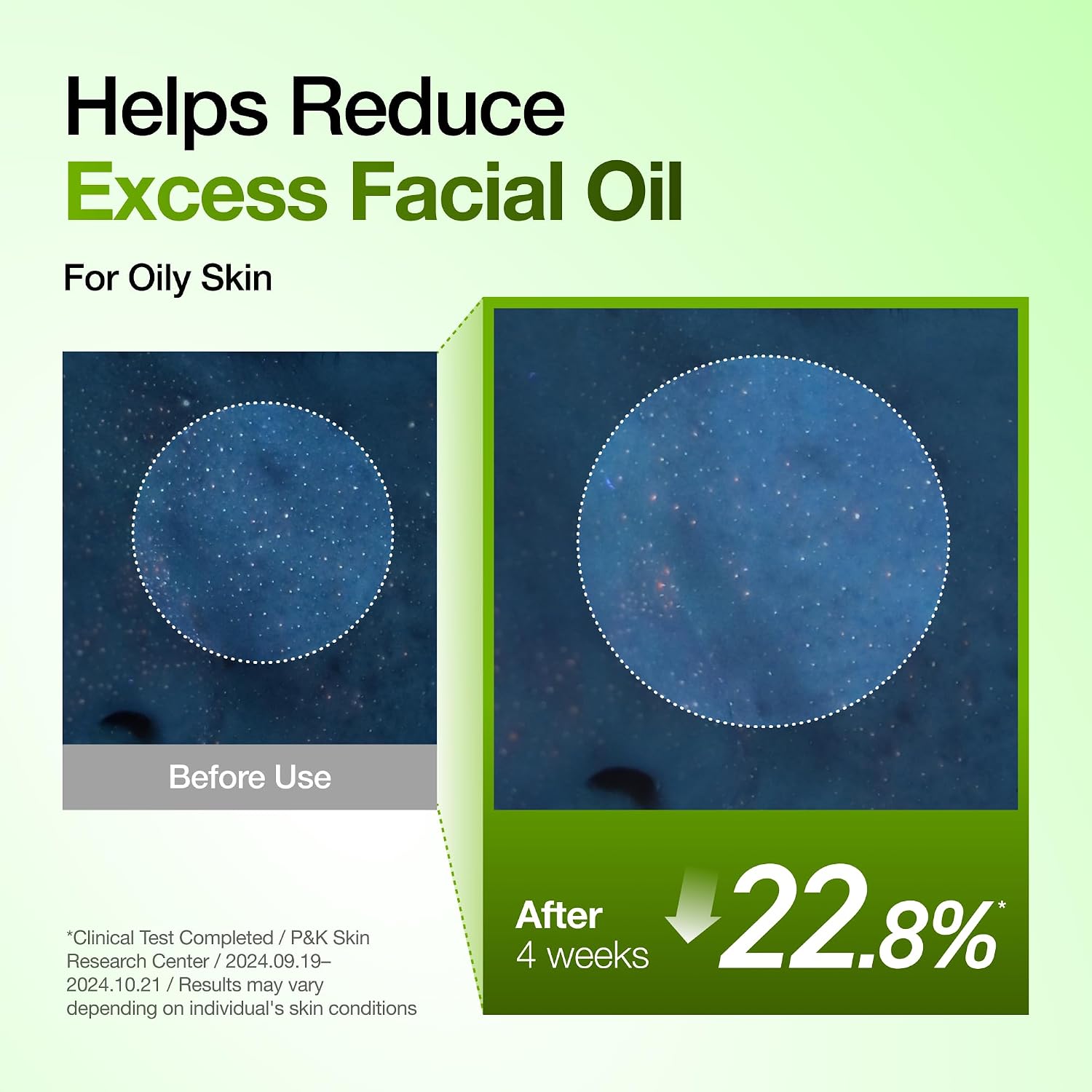 Anua Azelaic Acid 10 Hyaluron Redness Soothing Serum with Cica Soothes & Calms Acne-Prone Skin