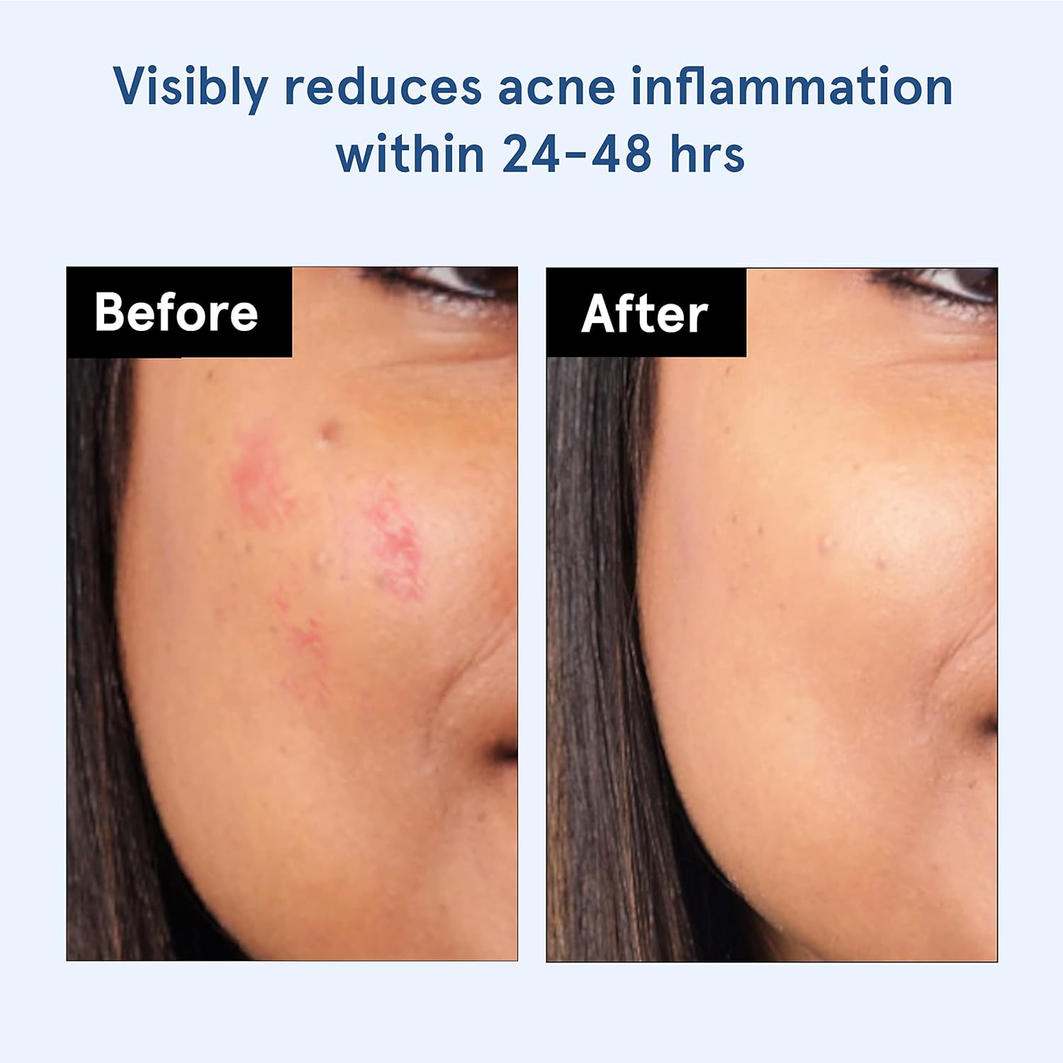 BeBodywise Hydrocolloid Acne Pimple Patch -24 pcs
