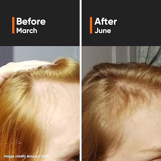 Minimalist Hair Growth Actives 18% Hair Serum - 30 ml