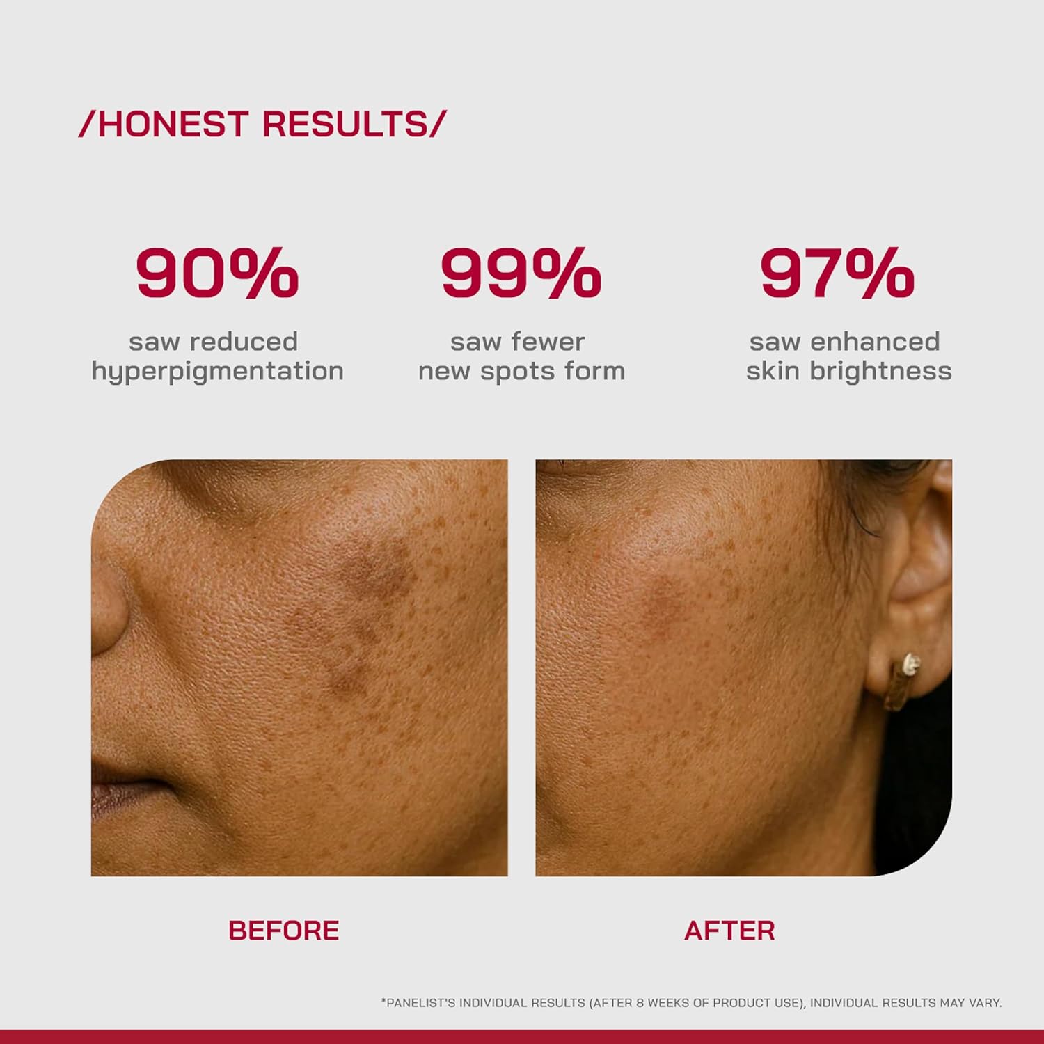 /PHD/ 2% Alpha Arbutin Depigmentation Serum | Alpha Arbutin for Pigmentation & Dark Spot | Pigmentation serum for Women & Men | Tyrobrightâ„¢, Niacinamide | Tan removal | Fragrance-Free | 10ml