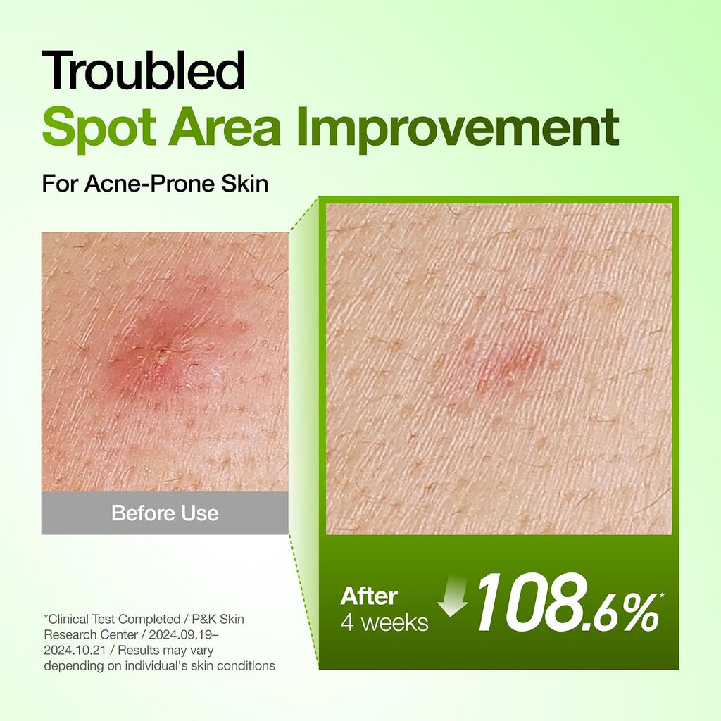 Anua Azelaic Acid 10 Hyaluron Redness Soothing Serum with Cica Soothes & Calms Acne-Prone Skin