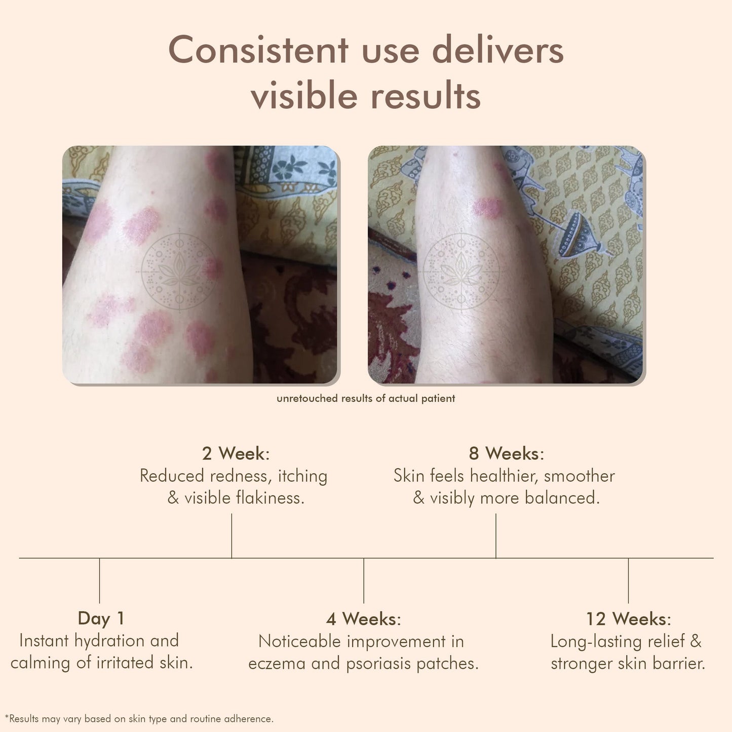 VedicDerm Oleander's Oil for Psoriasis, Eczema, and Atopic Dermatitis