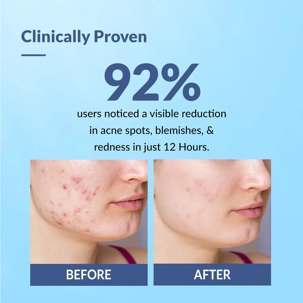 Fixderma Salyzap Acne Spot Corrector Gel - 20 gms