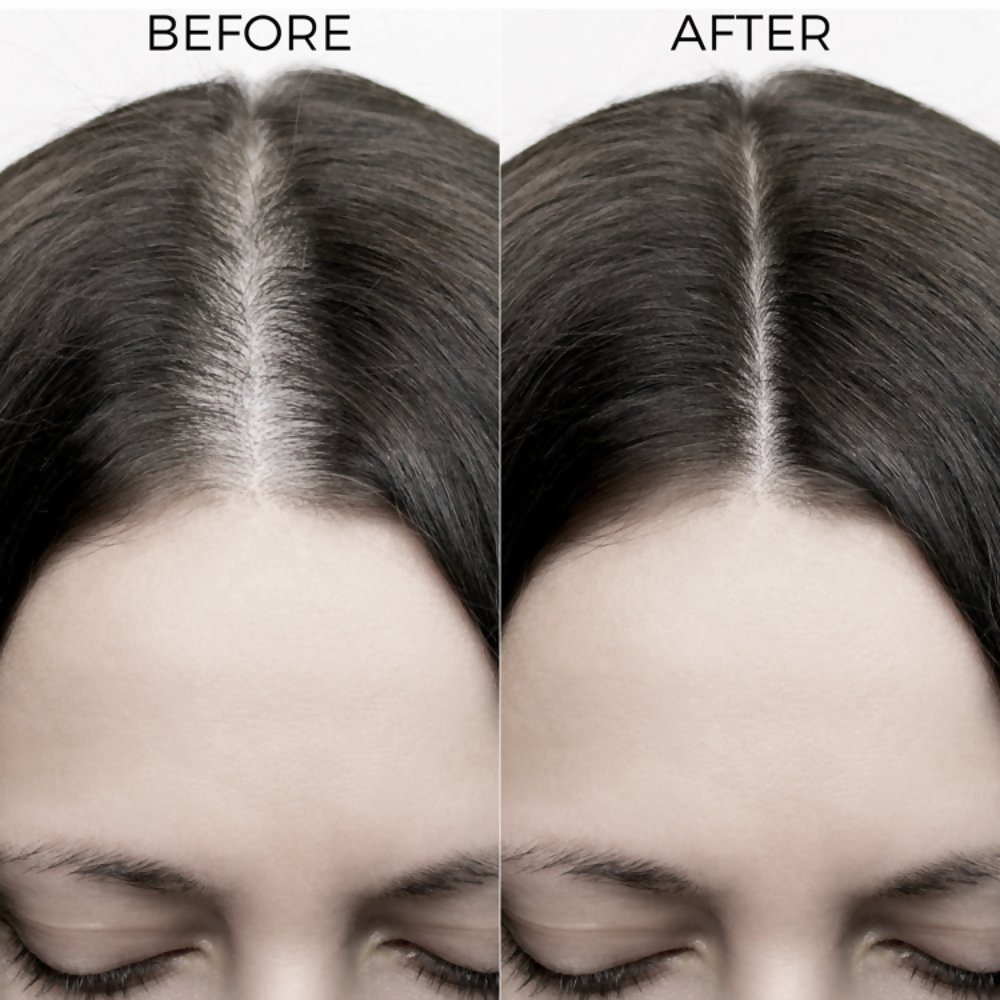 Brillare Onion & Bakuchiol Oil Shots For Hair Fall Reduction