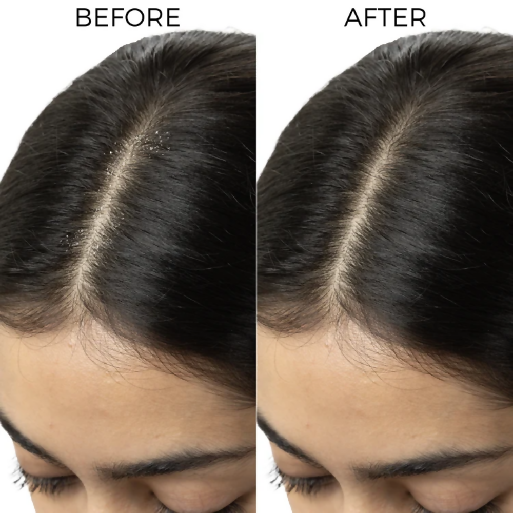 Brillare Dandruff Control Kit