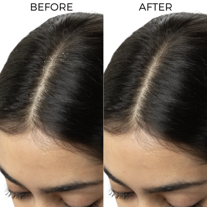 Brillare Dandruff Control Kit