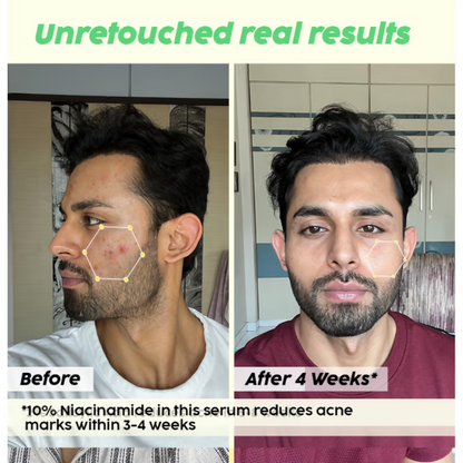 PLIX The Plant Fix 2% Acne Buster Moisturizer & 10% Niacinamide Serum