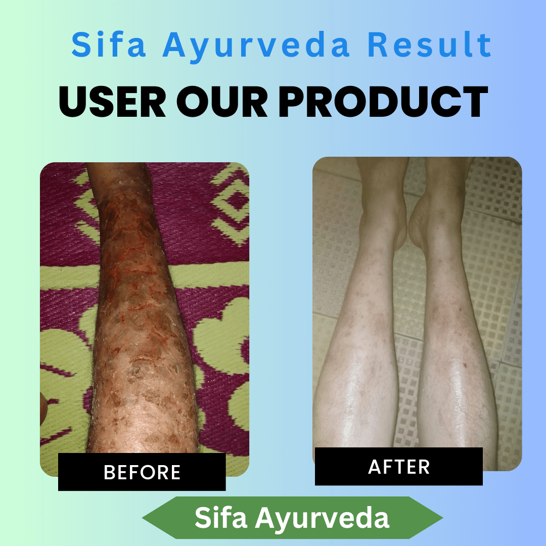 Sifa Ayurveda Psoriasis Capsule - 60 Caps