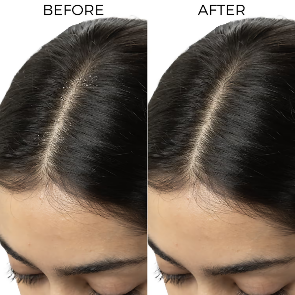 Brillare Tea Tree & Salicylic Oil Shots For Dandruff Control