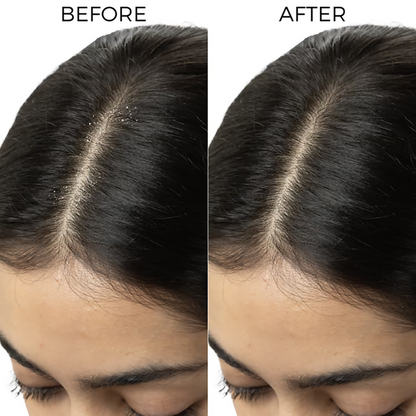 Brillare Tea Tree & Salicylic Oil Shots For Dandruff Control