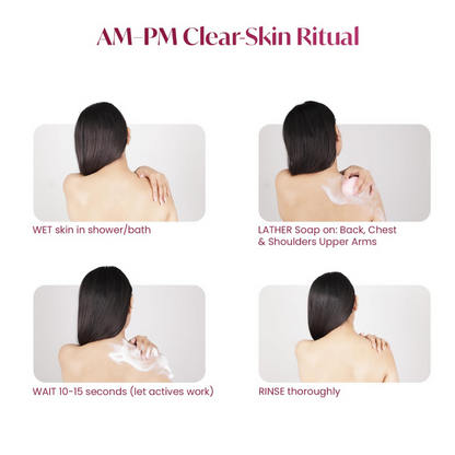Alite Anti-Acne Soap