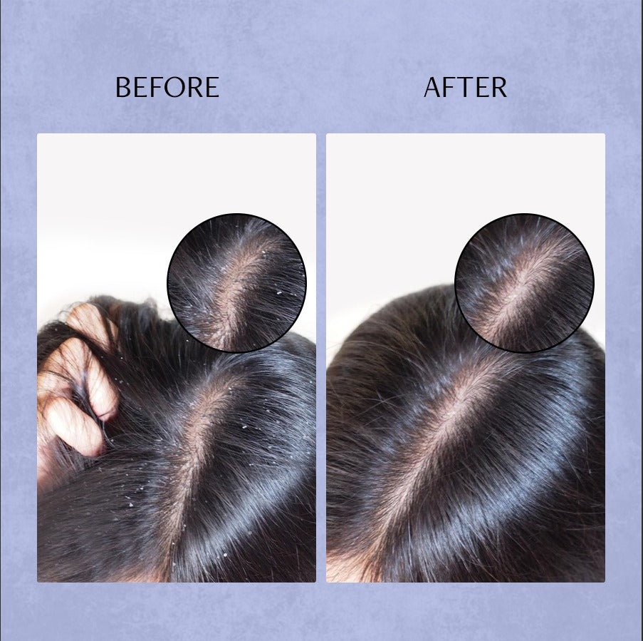 Deconstruct Anti Dandruff Serum for Scalp - 100 ml