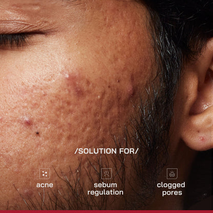 Proven Honest Derma (PHD) 2% Salicylic Acid Anti-Acne Serum