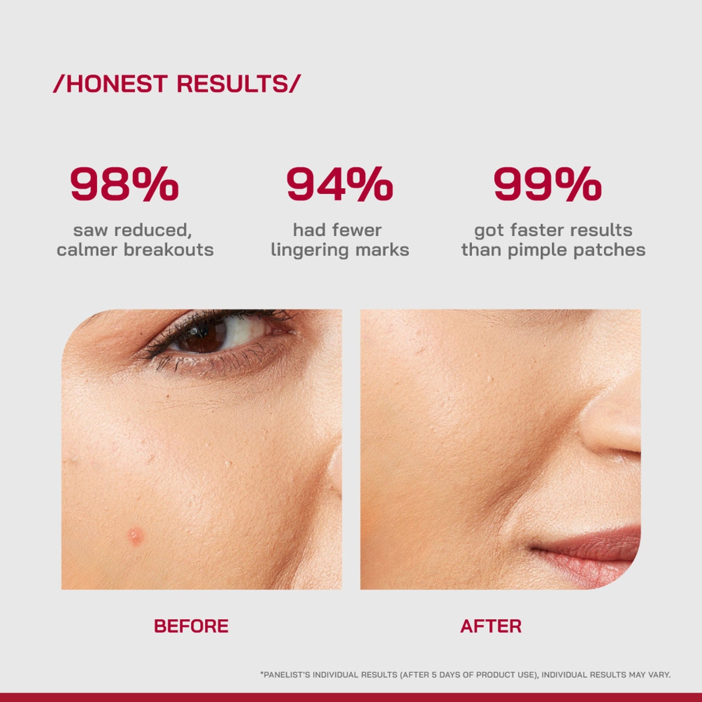 Proven Honest Derma (PHD) Salicylic Acid Acne Spot Gel