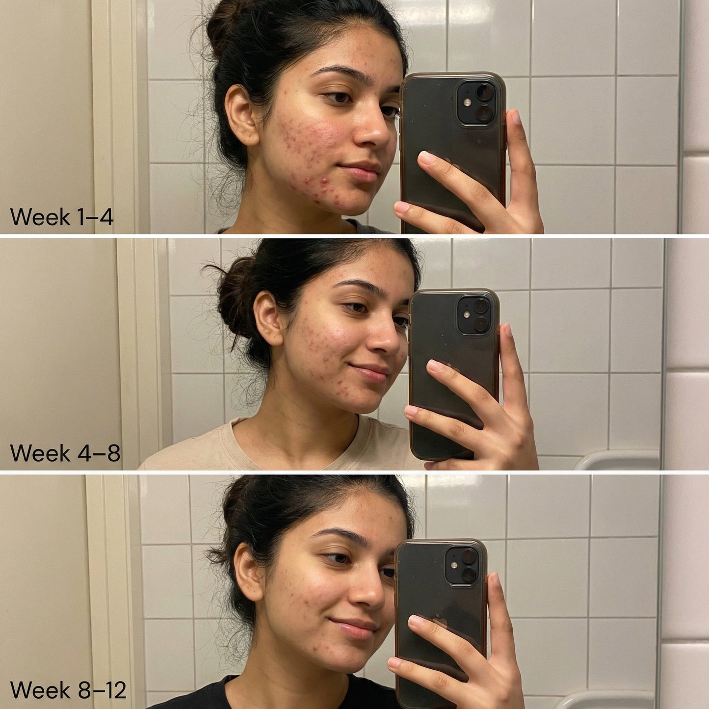 VedicDerm Nano Gold Acne Defence Cream with Turmeric and Nia-Cera-Peptide Complex™️