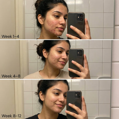 VedicDerm Nano Gold Acne Defence Cream with Turmeric and Nia-Cera-Peptide Complex™️