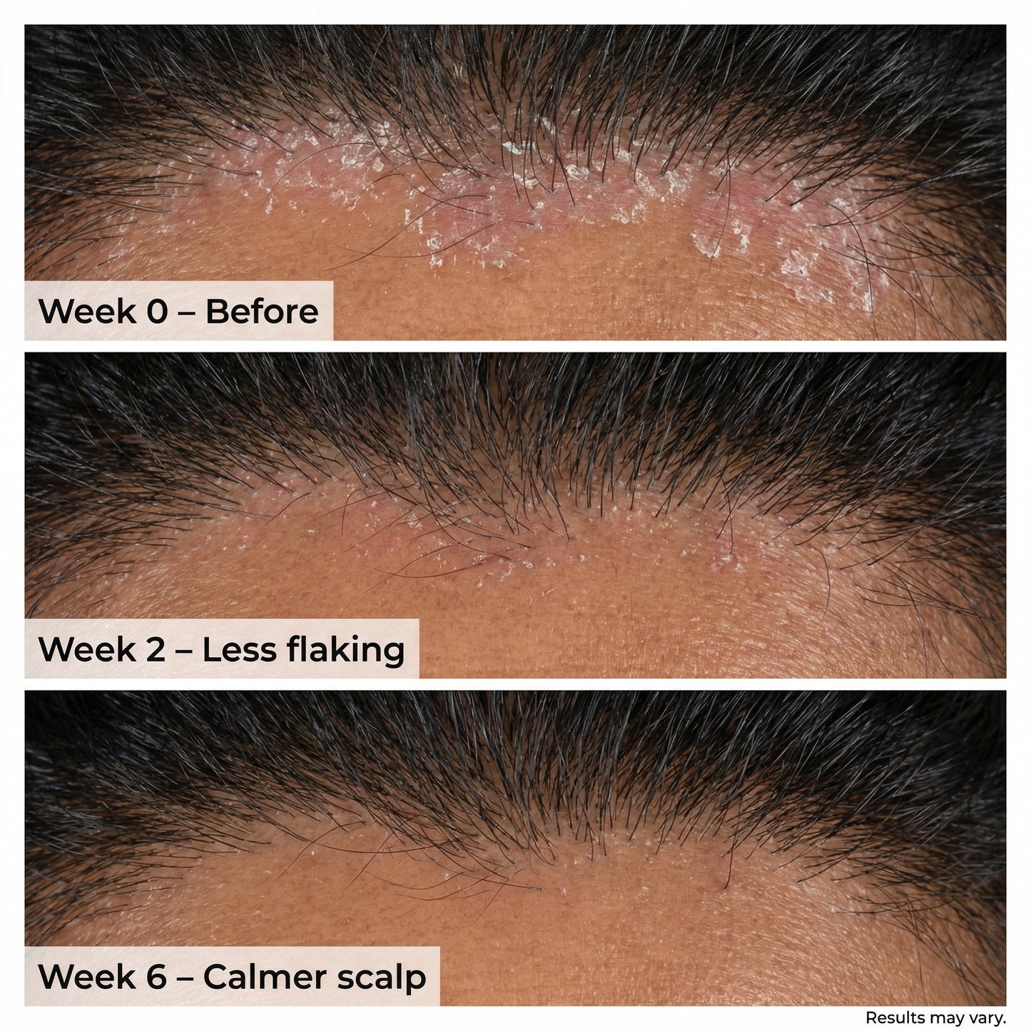 VedicDerm Sensitive Scalp Bundle for Psoriasis, Dandruff, & Itchy Scalp