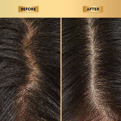 The Skin Story Anti-Dandruff Hair Scalp Serum