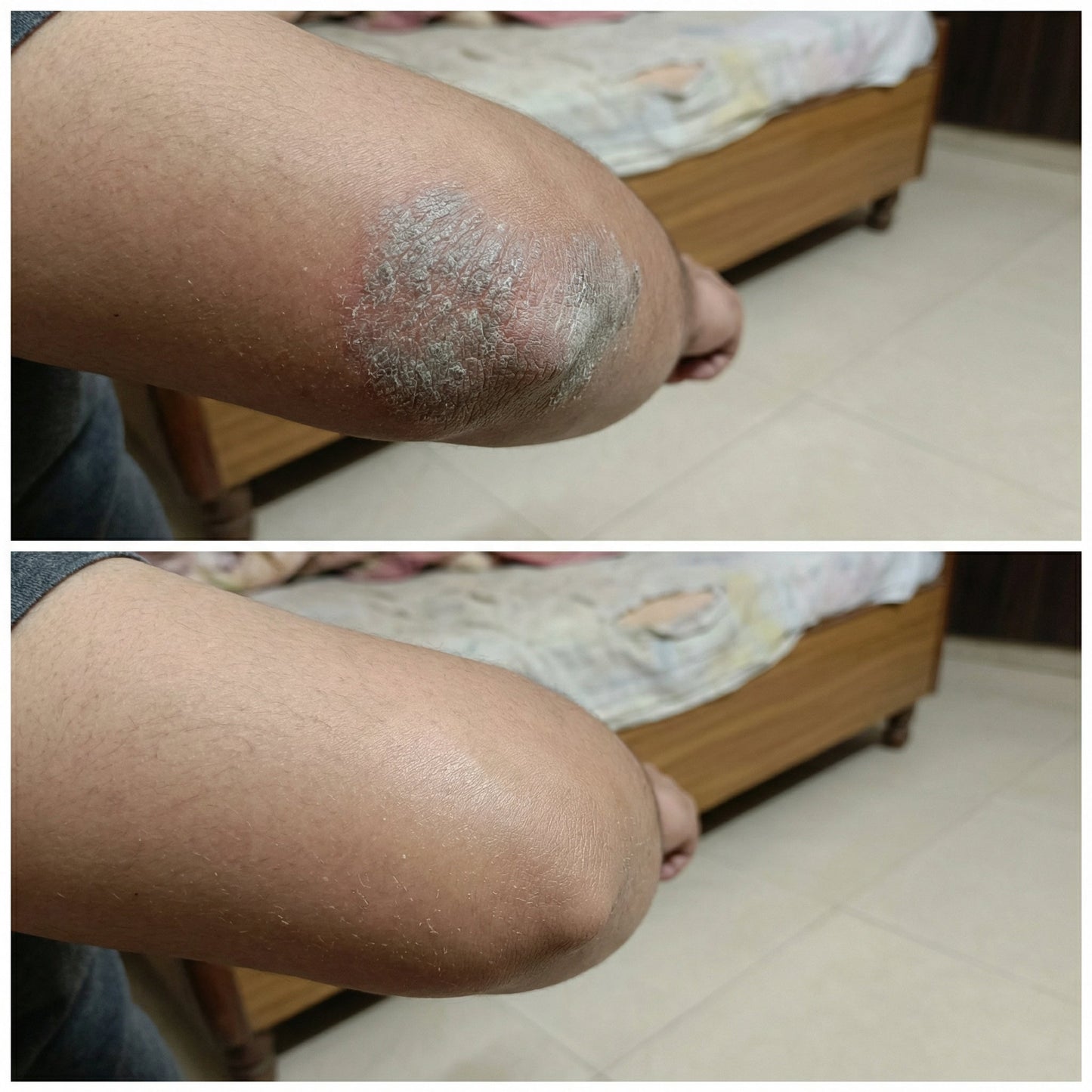 VedicDerm Sensitive Skin Bundle for Psoriasis, Eczema, Atopic Dermatitis