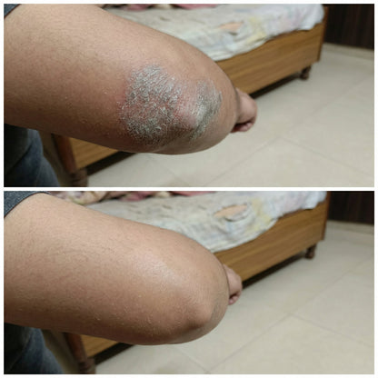 VedicDerm Sensitive Skin Bundle for Psoriasis, Eczema, Atopic Dermatitis