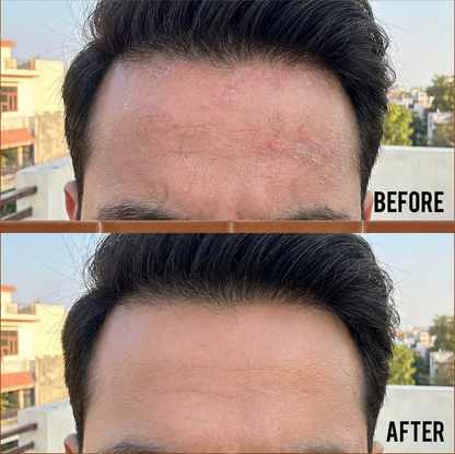 VedicDerm Sensitive Scalp Bundle for Psoriasis, Dandruff, & Itchy Scalp