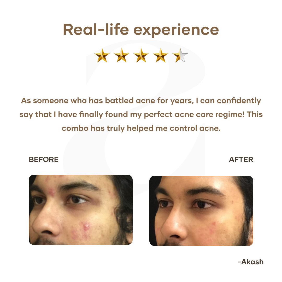 Mars by GHC Ultimate Acne Care Regime