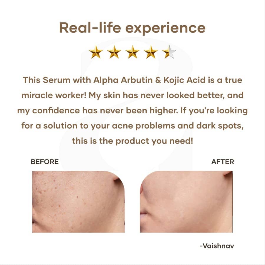 Mars by GHC Anti Acne Serum with Alpha Arbutin & Kojic Acid - 30 ml
